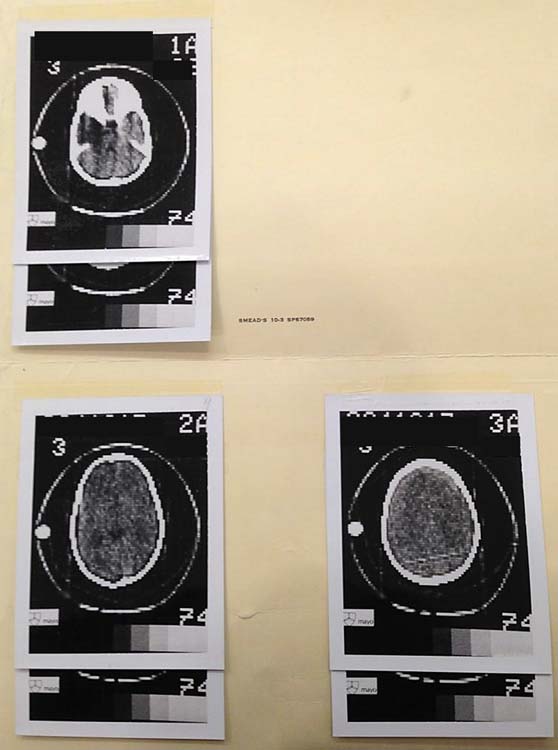 Head CT exam from 1973